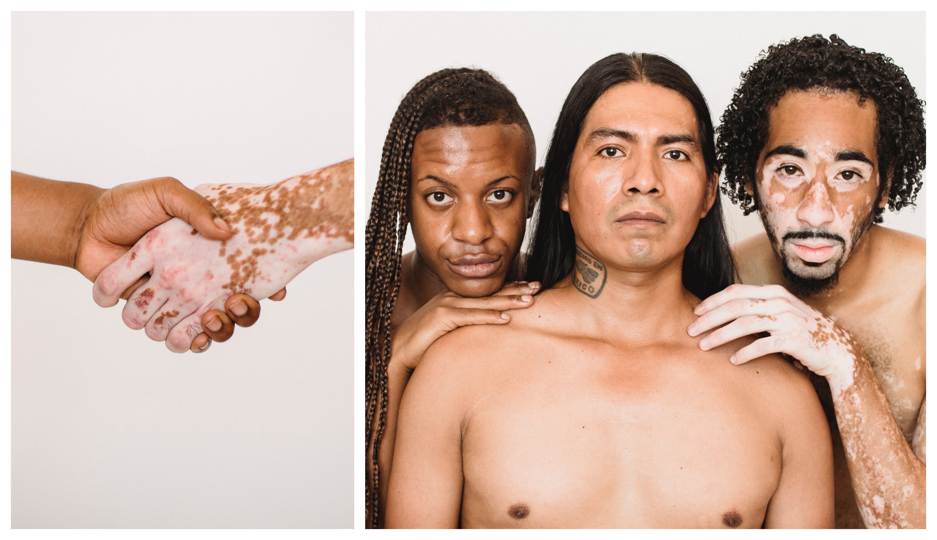 Hudsjukdomen Vitiligo Symtom Behandling Och rftlighet